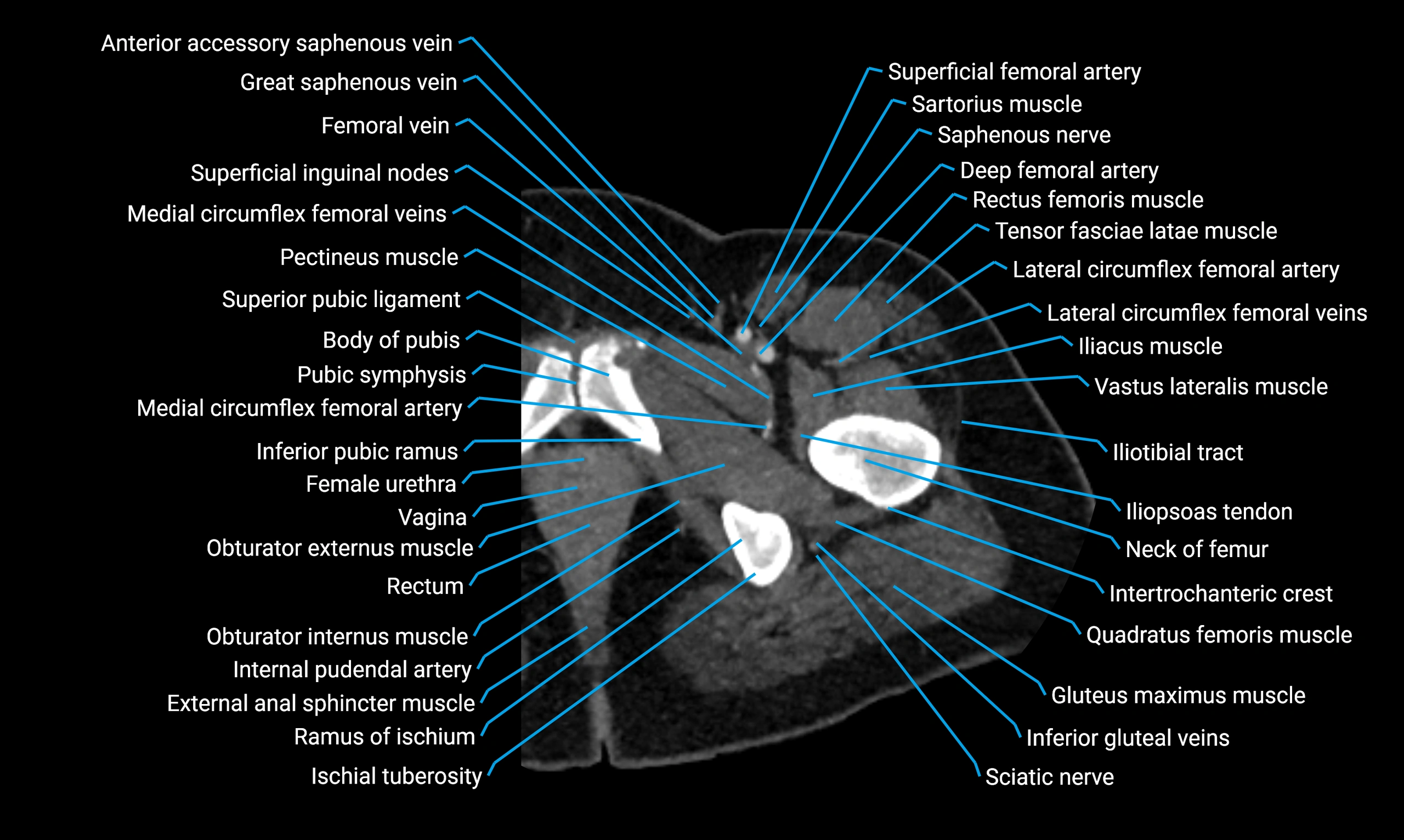 CT thigh axial cross sectional anatomy labelled image_14 (2).webp